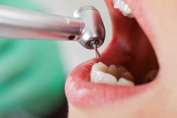 Best Emergency Treatment for Dental Infections or Abscesses in Home Garden, CA